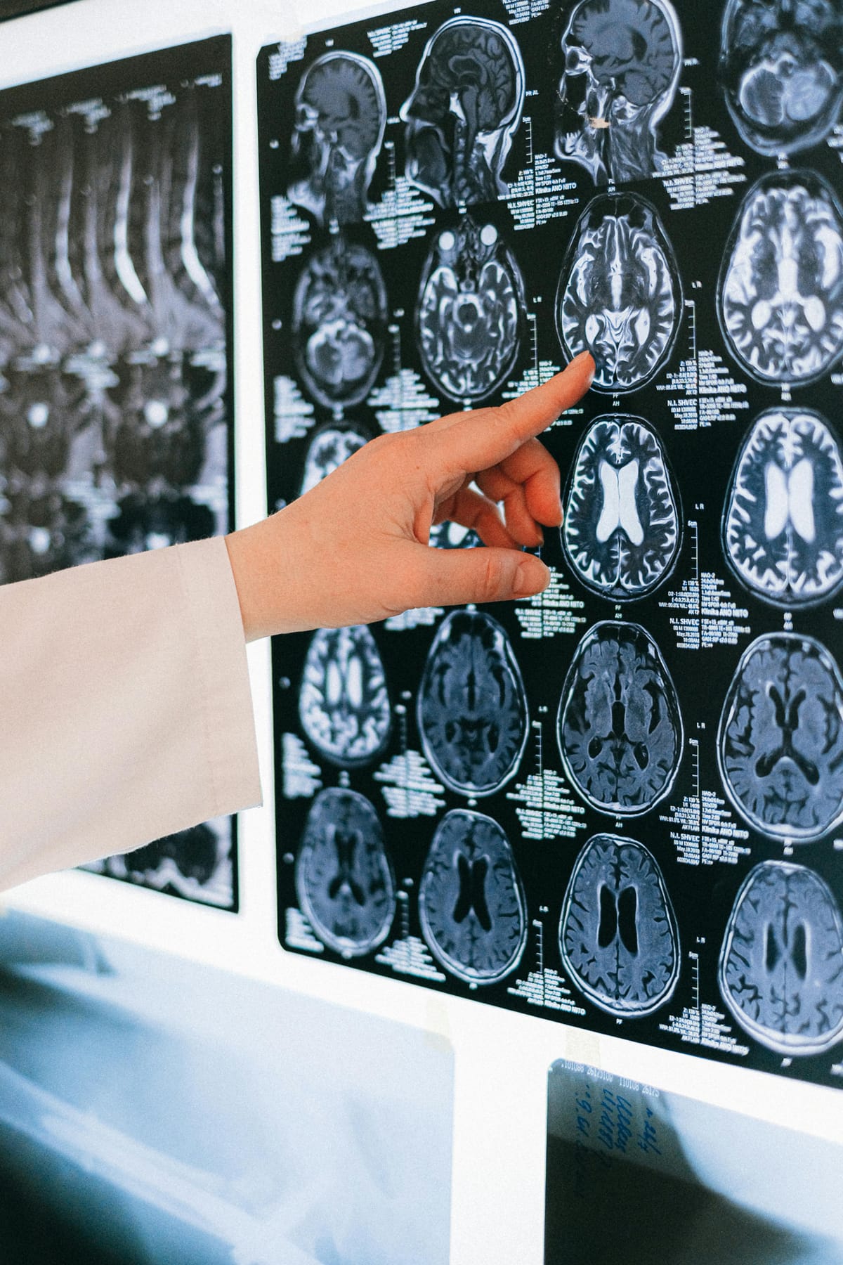 Detecting Cancer with Machine Learning and Computer Vision Models